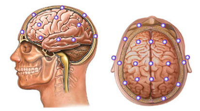 Electroencephalogram (EEG)