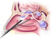 Endoscopy Brain