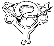 Herniation of disc material results in nerve root pressure and irritation.