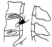 Herniation of disc material results in nerve root pressure and irritation.