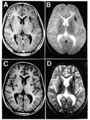 Intraoperative MRI