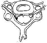 Stenosis limits room in the foramen creating nerve root and spinal cord pressure