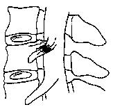 Stenosis limits room in the foramen creating nerve root and spinal cord pressure