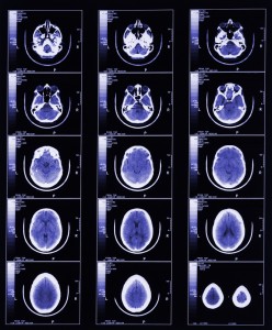 brain-mri-lucia-zamorano