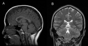 Inflammation as a New Therapeutic Approach For Alzheimer’s Disease