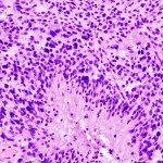 Glioblastoma