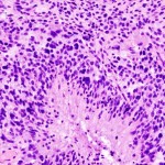 Glioblastoma